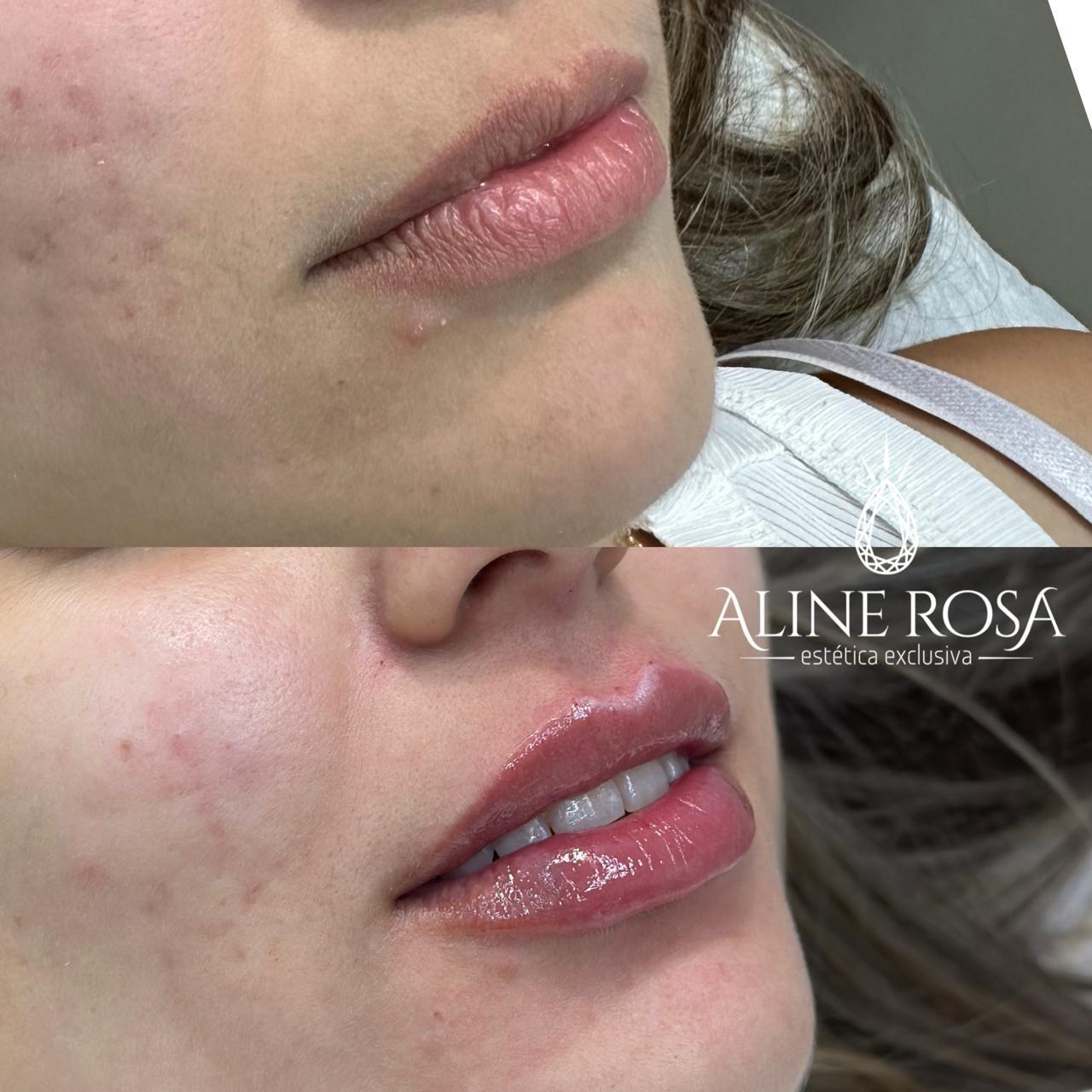 Estruturação Labial